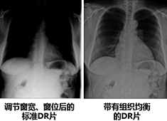 影響醫用X射線影像設備成像質量的主要指標和因素