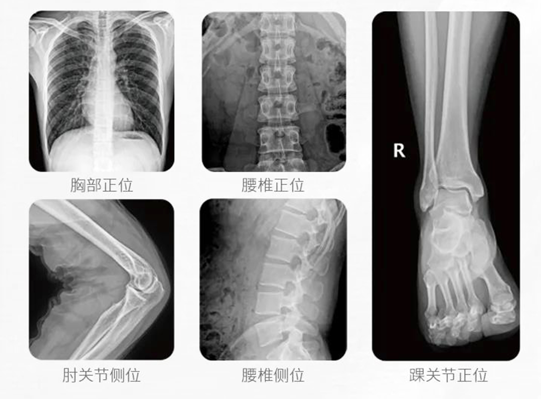 大功率移動(dòng)DR臨床影像