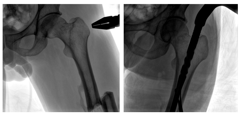 移動式一體化C形臂釘點至骨折部位的臨床影像