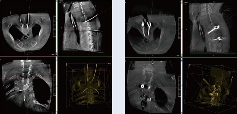 術中三維C形臂影像在脊柱導航機器人系統中的應用