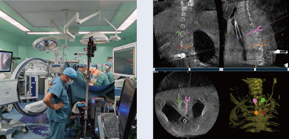 三維C臂與骨科手術(shù)機(jī)器人的組合應(yīng)用