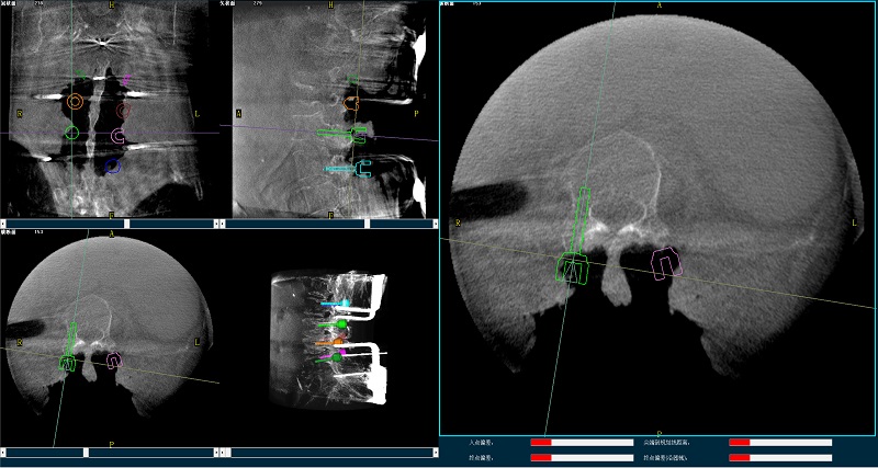 機器人輔助腰椎后路側(cè)彎矯形手術(shù)規(guī)劃圖像